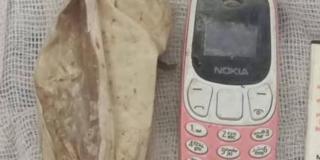 الفريق الطبي بمستشفى ناصر بشبرا ينجح في استخراج "موبيل" من معدة مريض بعد 4 شهور (صور)