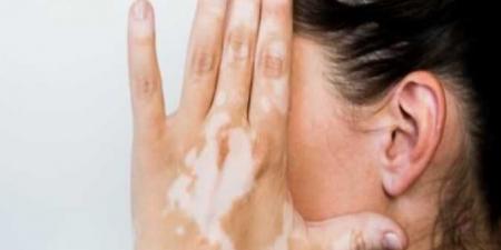 طفلك مصاب بالبهاق؟ هكذا تعزز ثقته بنفسه