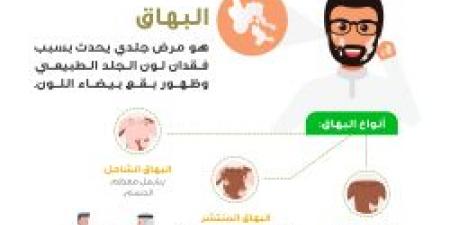 ما هو البهاق وما أنواعه ؟ وزارة الصحة تجيب على ذلك