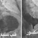 دراسة جديدة تكشف مفاجأة عن القلب المنكسر